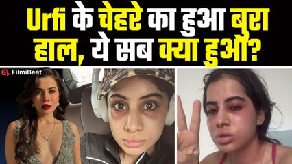 Urfi Javed’s whole face got spoiled, fans are worried after seeing her&nbsp;condition